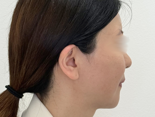 脂肪吸引（顔）施術後
