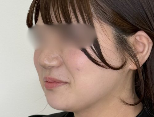 脂肪吸引（顔）施術後