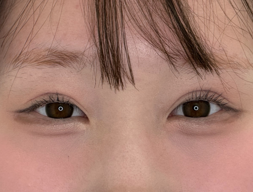 二重埋没 施術後