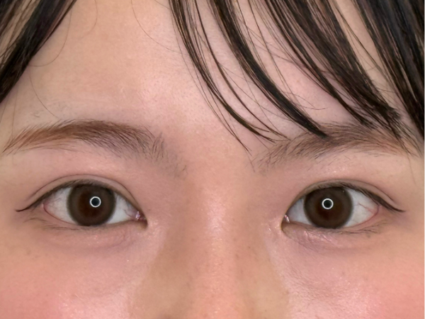 二重埋没 施術後