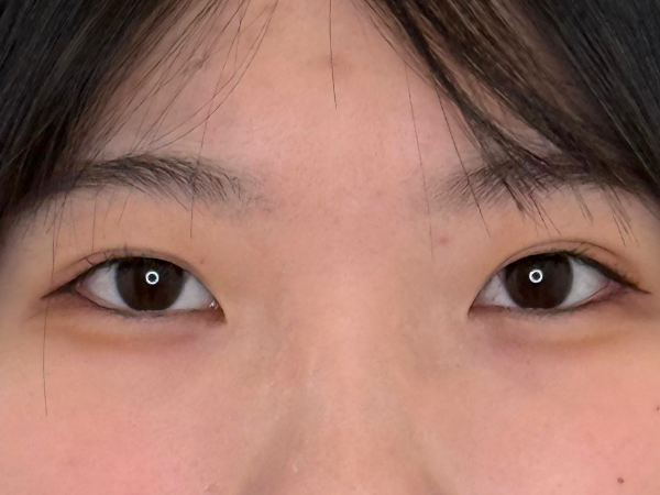 二重埋没 施術後