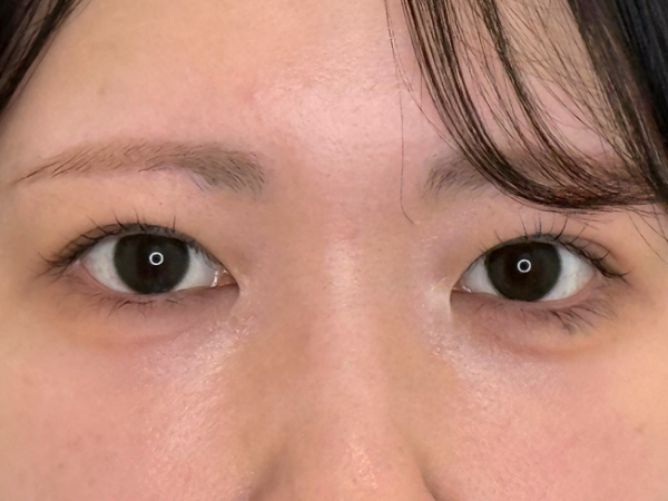 二重埋没 施術後