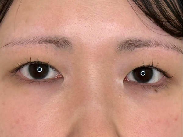 二重埋没 施術前